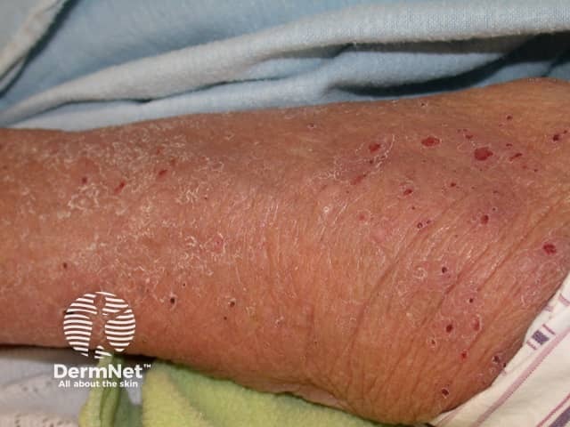 Bullous pemphigoid