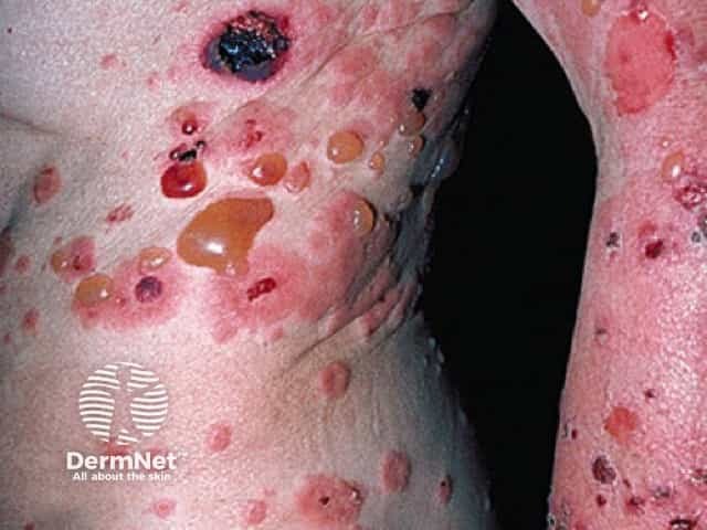 Bullous pemphigoid