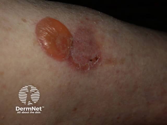 Bullous pemphigoid