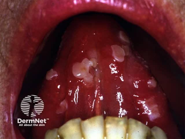 Oral pemphigus vulgaris