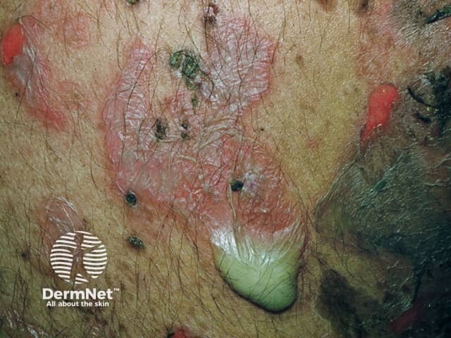 Pemphigus vulgaris