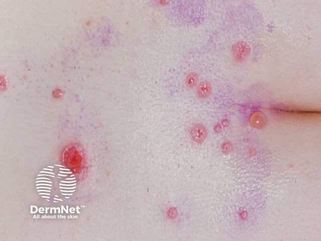 Pemphigus vulgaris