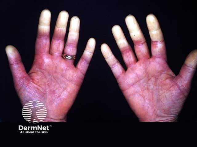 Raynaud phenomenon