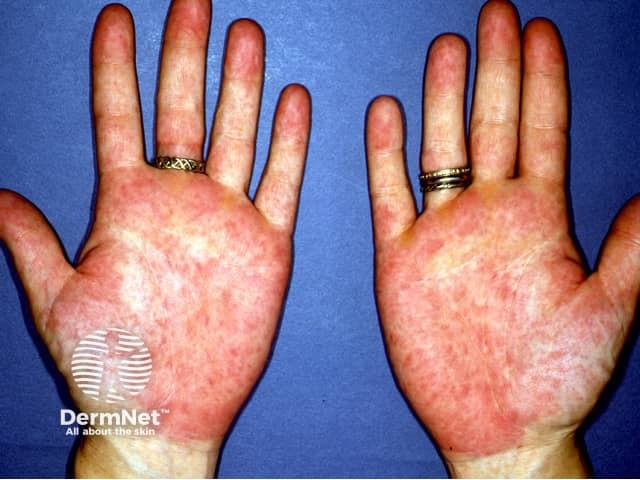 Palmar erythema