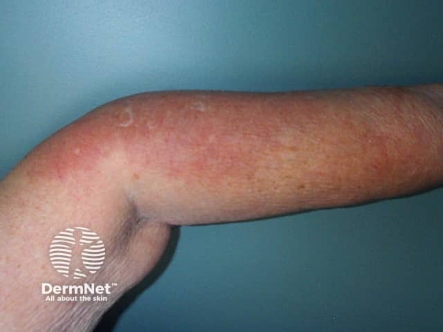 Neutrophilic dermatosis associated with rheumatoid arthritis