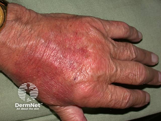 Neutrophilic dermatosis associated with rheumatoid arthritis