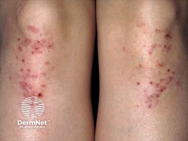 Dermatitis herpetiformis