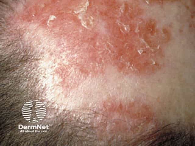 Discoid lupus erythematosus