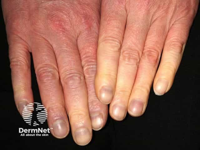 Raynaud phenomenon