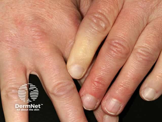 Raynaud phenomenon in dermatomyositis