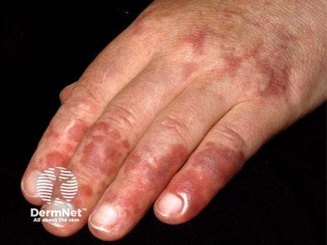 Systemic lupus erythematosus