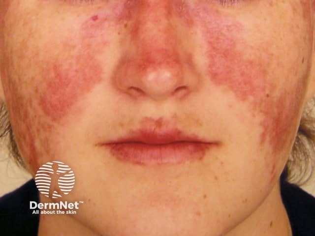 Malar 'butterfly' rash