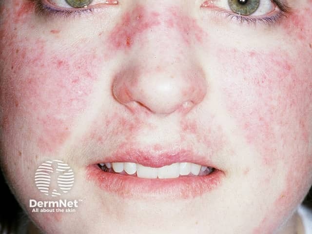 Systemic lupus erythematosus