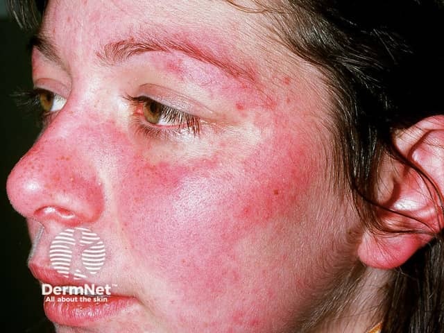 Systemic lupus erythematosus