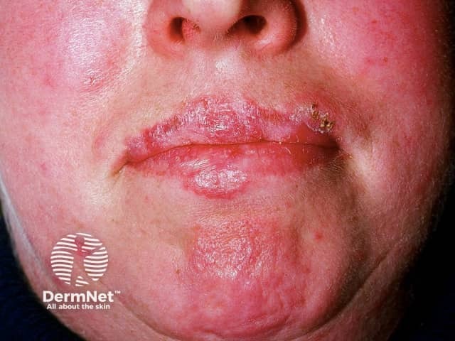 Systemic lupus erythematosus