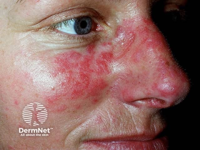 Systemic lupus erythematosus