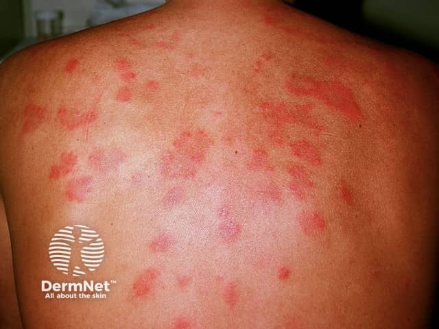 Systemic lupus erythematosus