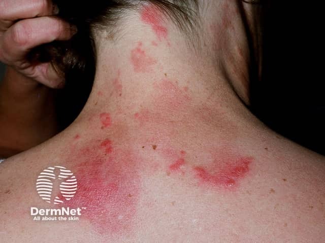 Systemic lupus erythematosus