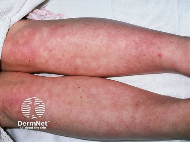 Systemic lupus erythematosus