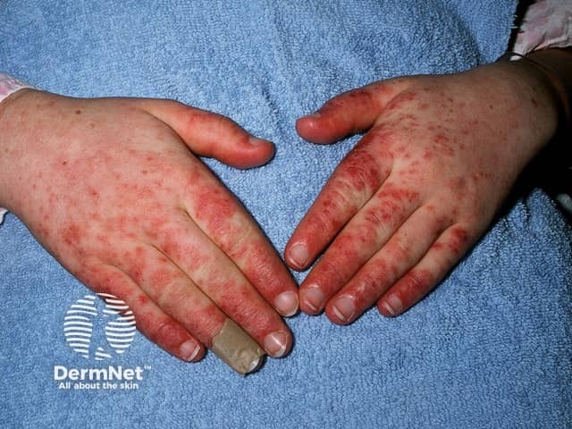 Systemic lupus erythematosus