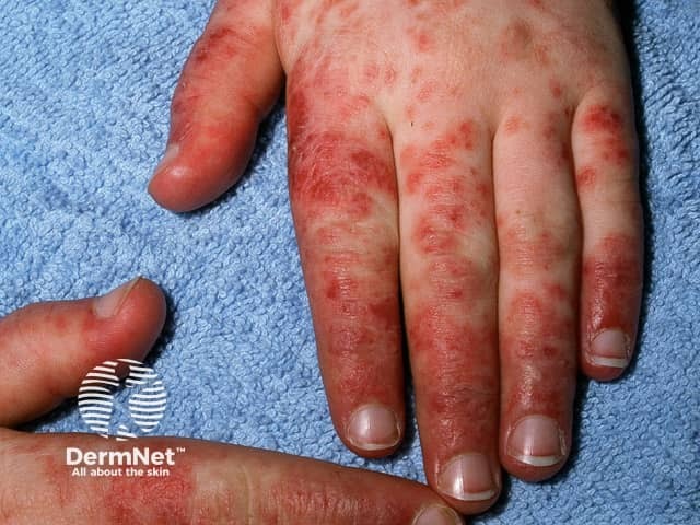 Systemic lupus erythematosus