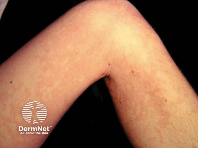 Systemic lupus erythematosus