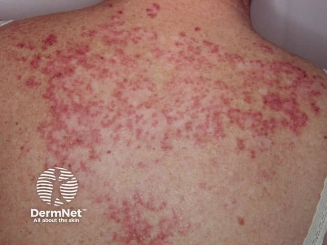 Systemic lupus erythematosus