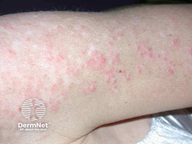 Systemic lupus erythematosus