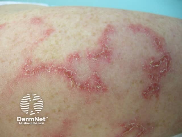 Systemic lupus erythematosus