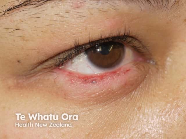 Chronic discoid lupus erythematosus