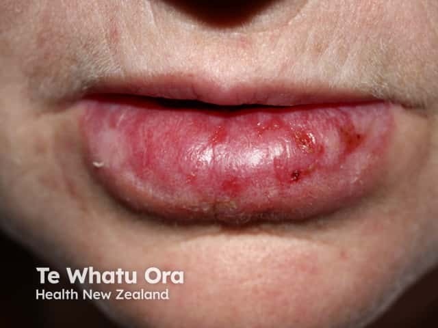 Discoid lupus erythematosus on lip