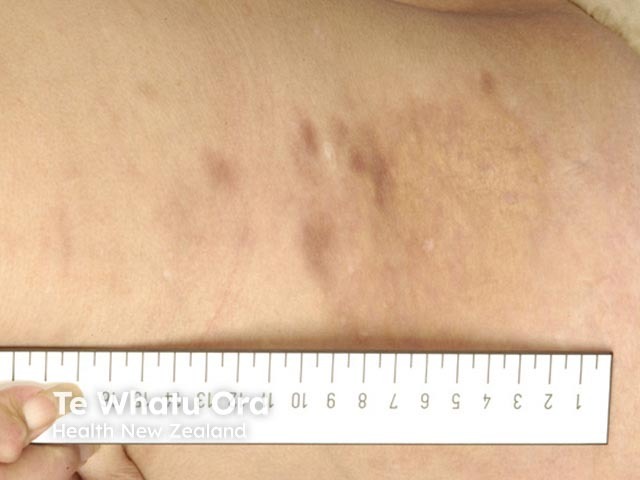 Systemic lupus erythematosus