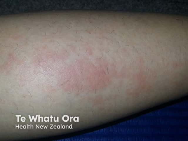 Papular erythema of generalised ACLE