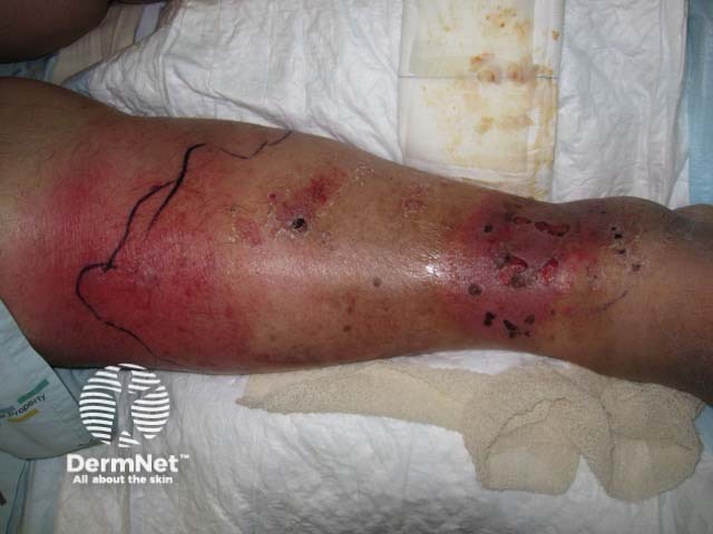 Cellulitis around venous ulcer