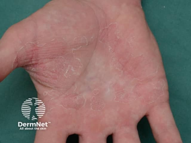 Palmar dermatitis