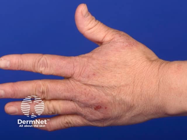 Hand dermatitis