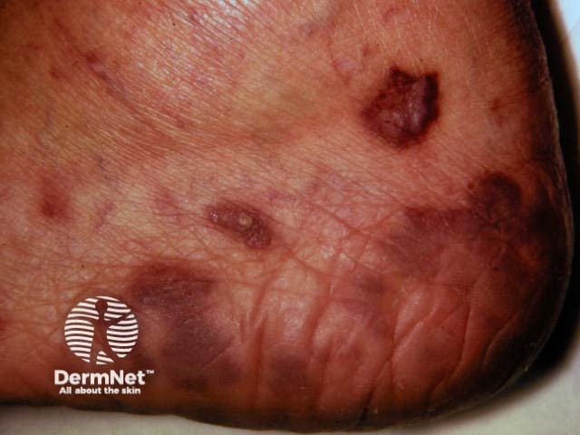 Kaposi sarcoma