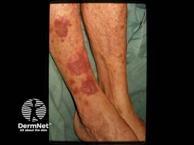 Kaposi sarcoma