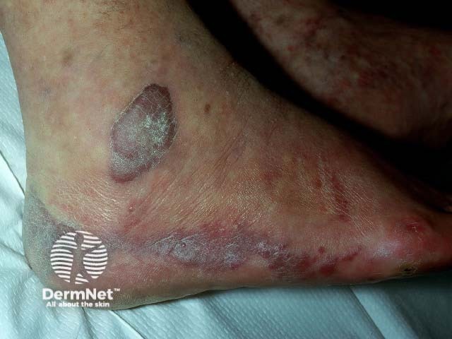 Kaposi sarcoma