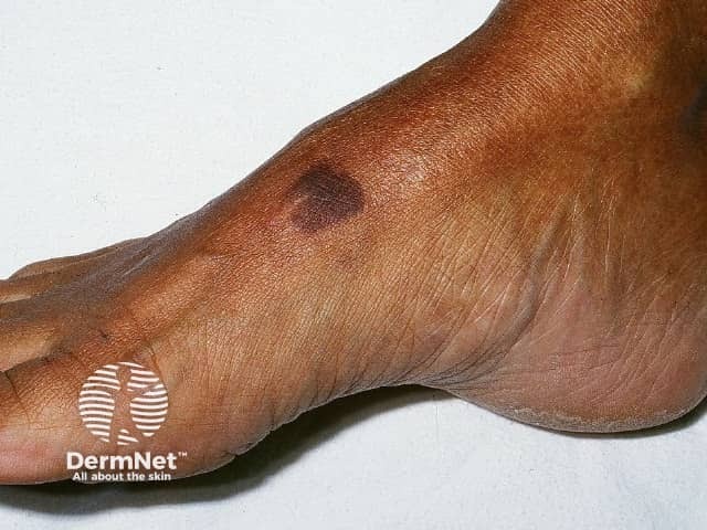 Kaposi sarcoma