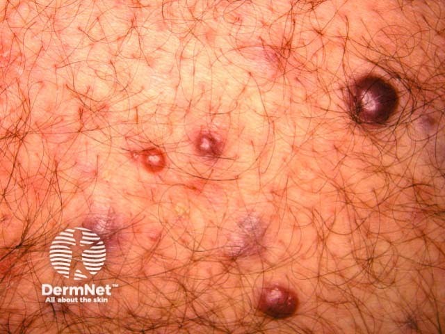 Kaposi sarcoma