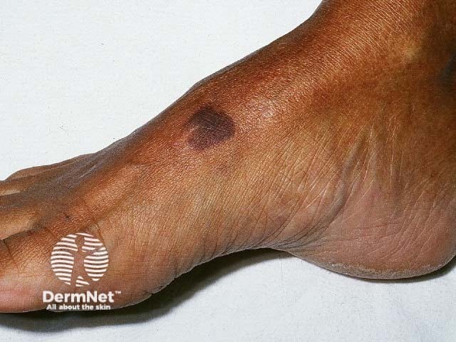 Localised Kaposi sarcoma