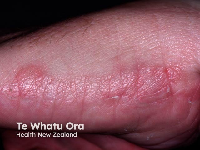 Keratolytic winter erythema