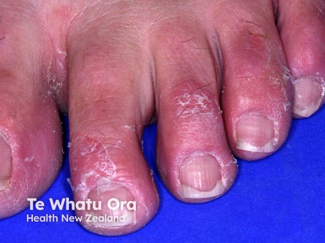 Keratolytic winter erythema