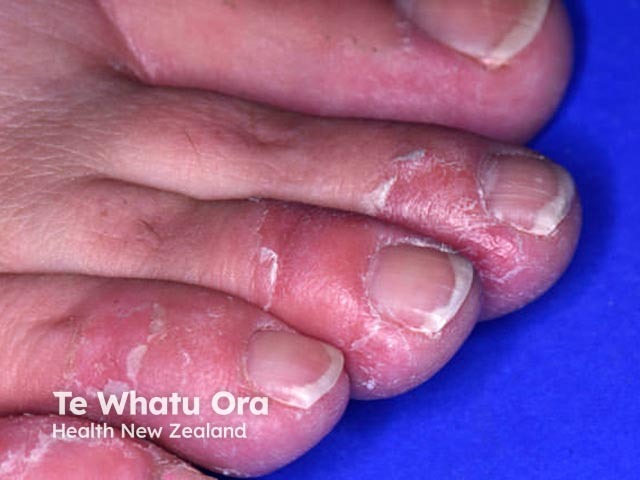 Keratolytic winter erythema