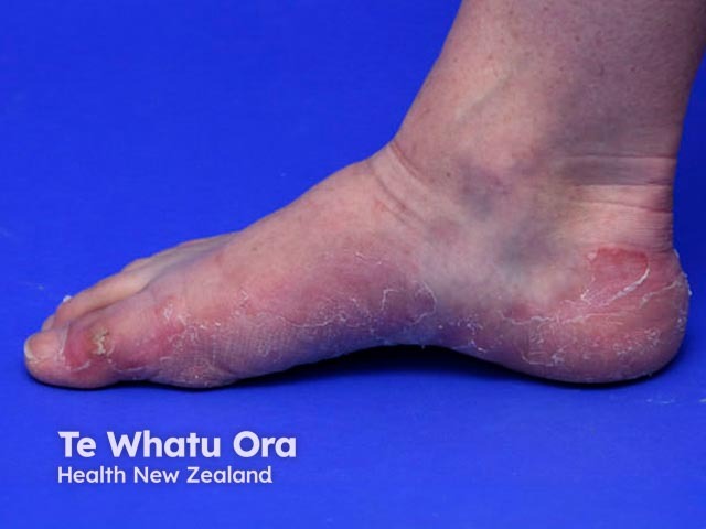 Keratolytic winter erythema