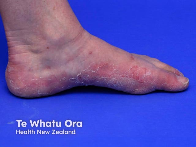 Keratolytic winter erythema