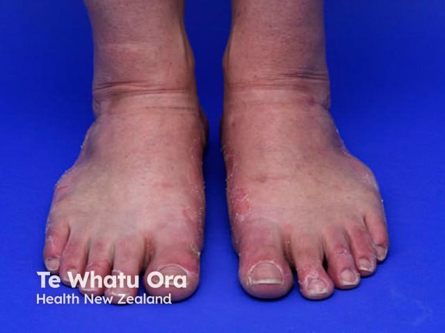 Keratolytic winter erythema