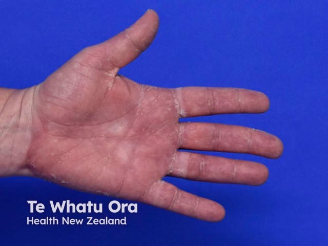 Keratolytic winter erythema