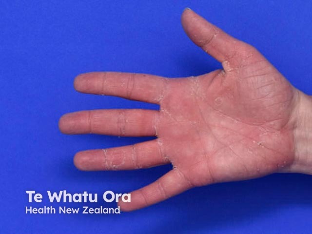 Keratolytic winter erythema